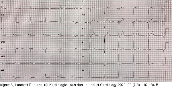 EKG - Notaufnahme