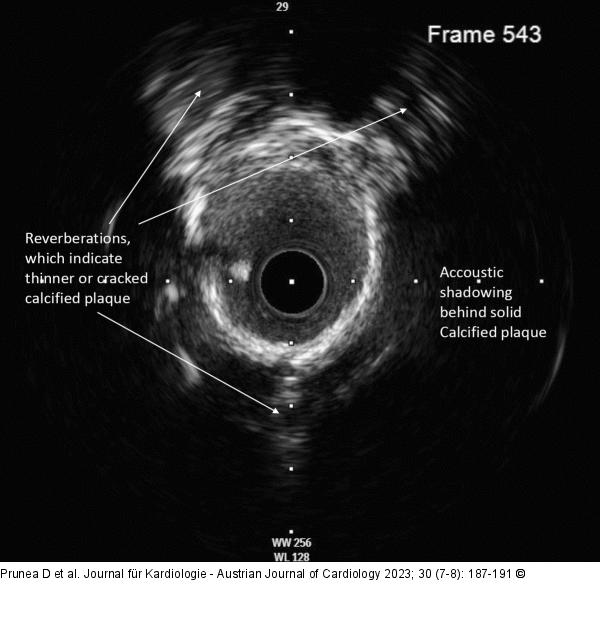 IVUS