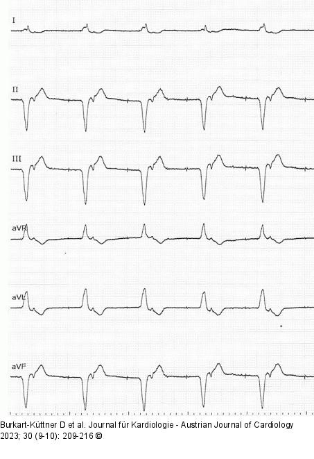 EKG