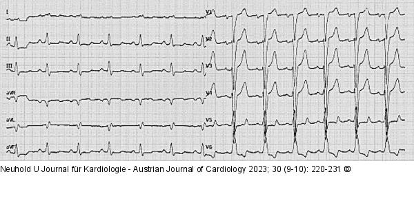 EKG