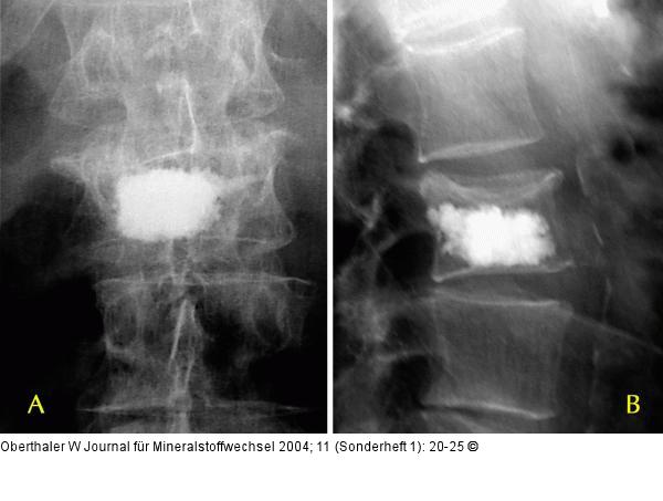 Vertebroplastie