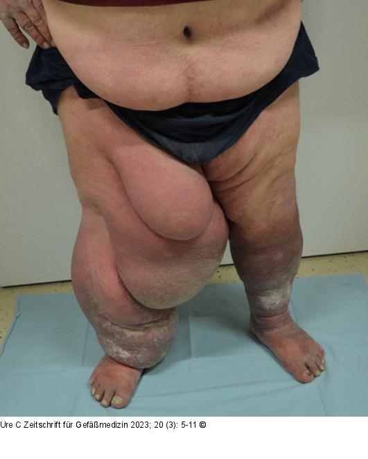 Beinlymphödem