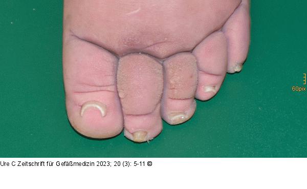 Papillomatosis  cutis lymphostatica