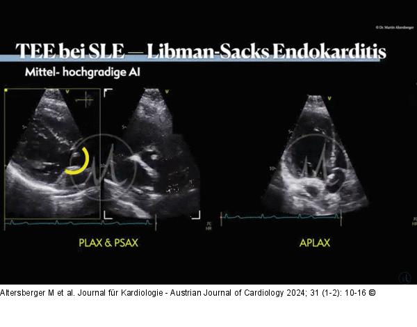 Libman-Sacks-Endokarditis