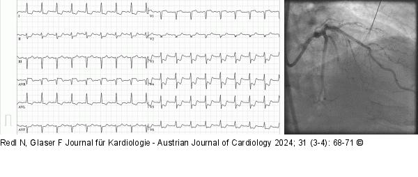 EKG - Angiographie