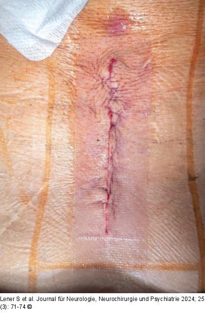 Dermabond® + Prineo®
