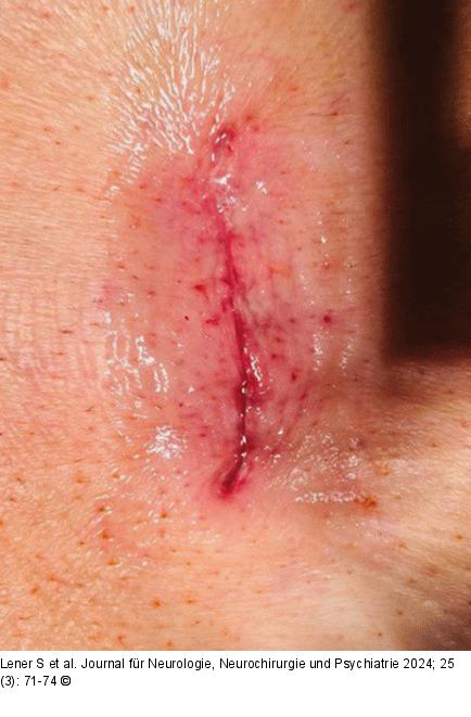 Dermabond®