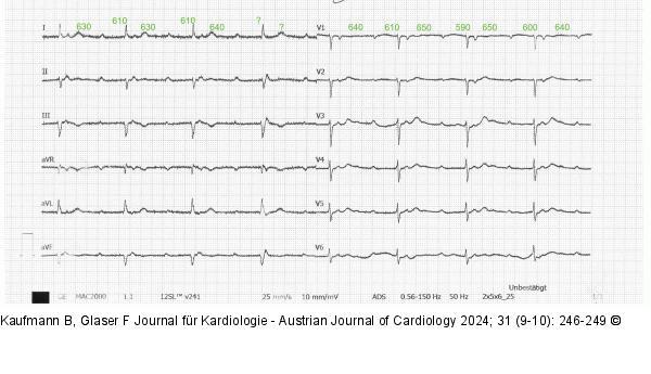 EKG