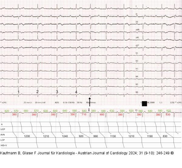 EKG