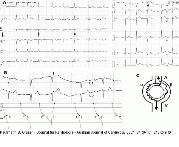EKG