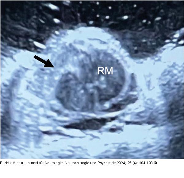 Intraoperative Sonographie