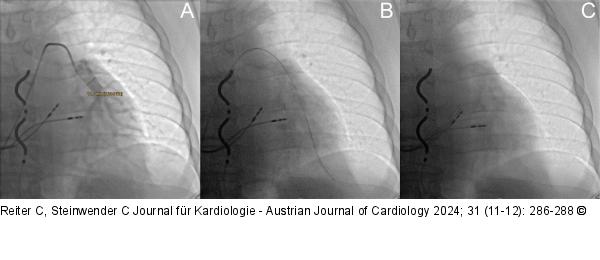 CardioMEMS™ HF-System - Implantation