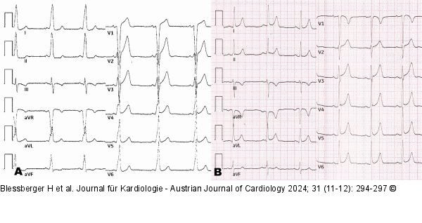Ablation