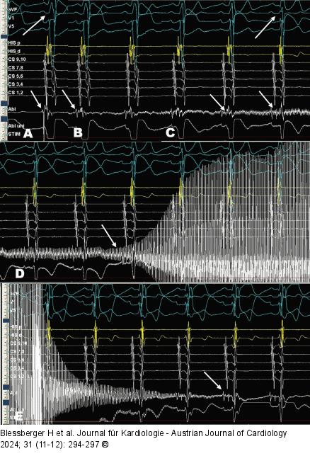 Kryo-Ablation