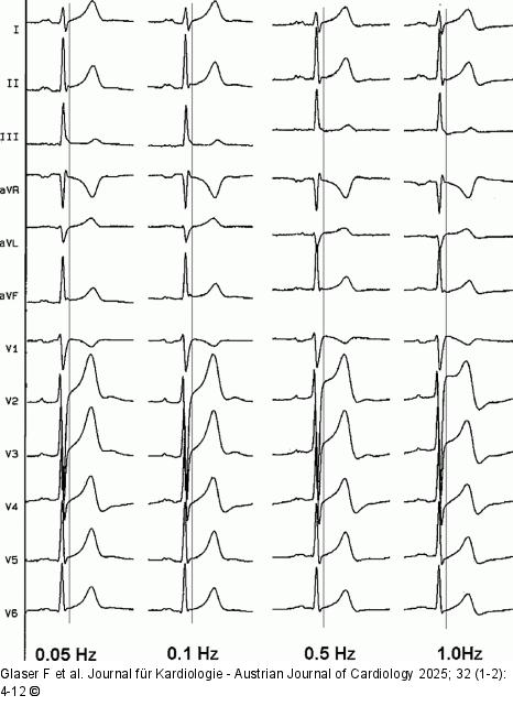 High-Pass-Filter