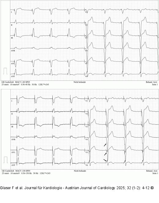 Low-Pass-Filterung