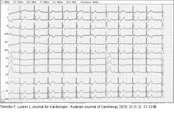12-Ableitungs-EKG