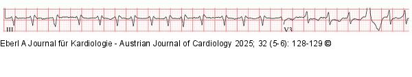 EKG