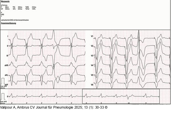 EKG