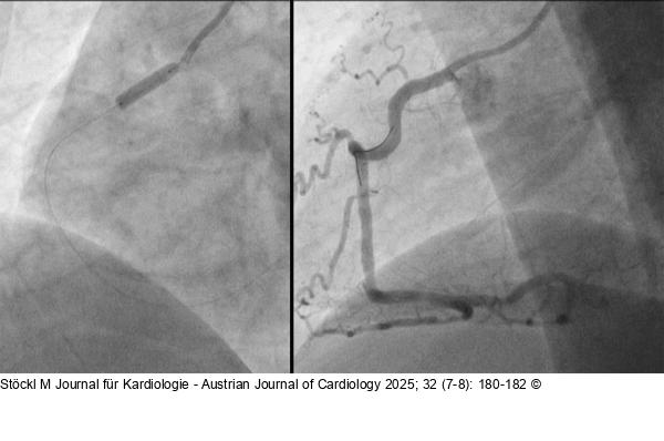 RCA: Angioplastieergebnis