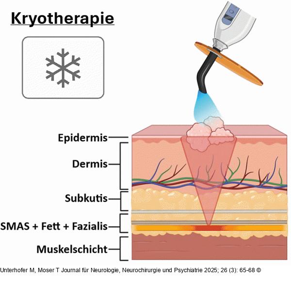 Kryotherapie