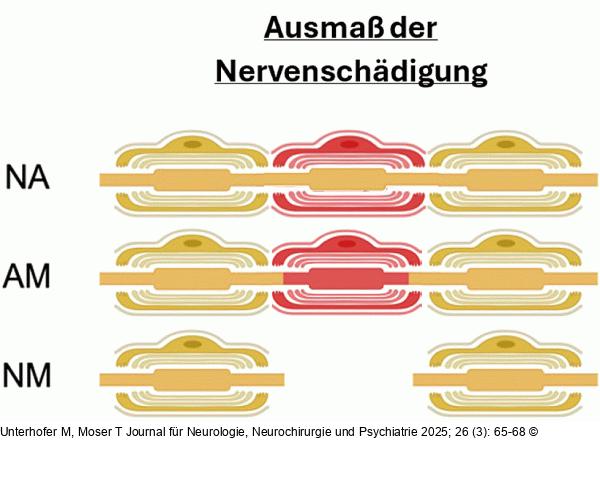 Nervenläsionen