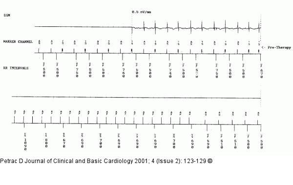 Vorhofflimmern - Antitachykardes Pacing