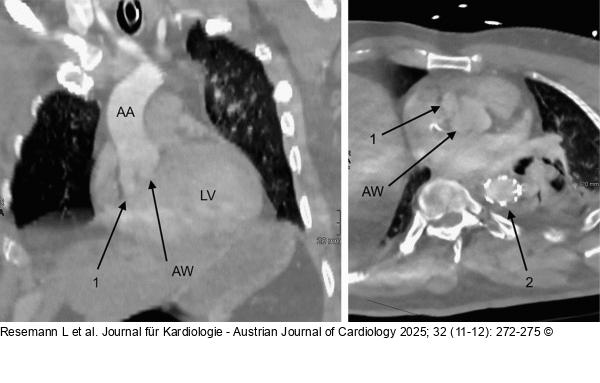 Aorten-CT