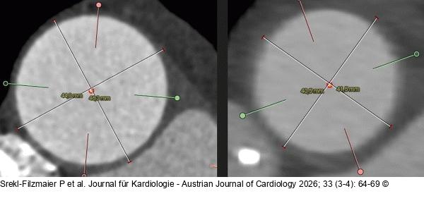 Aorta ascendens