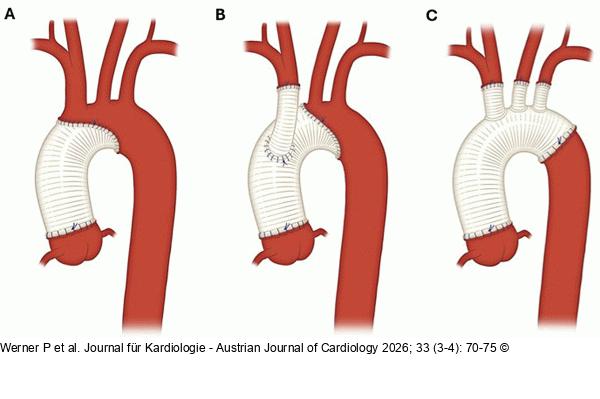 Aortenbogenersatz