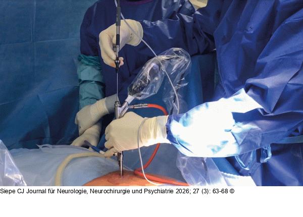 Vollendoskopische Operation