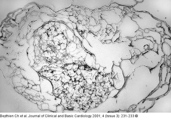 Thrombus - Aspirin