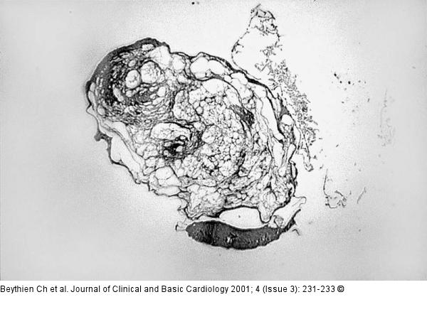 Thrombus - Aspirin