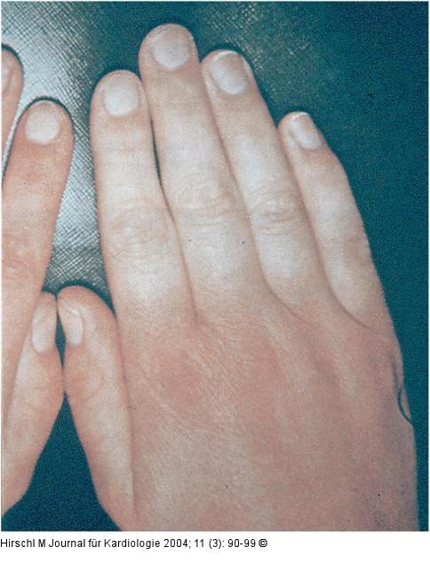 Raynaud-Phänomen