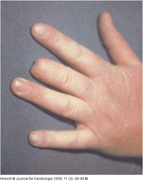 Raynaud-Phänomen