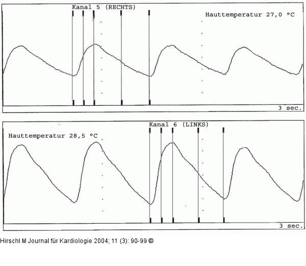 Raynaud-Phänomen