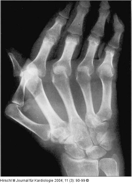 Raynaud-Phänomen