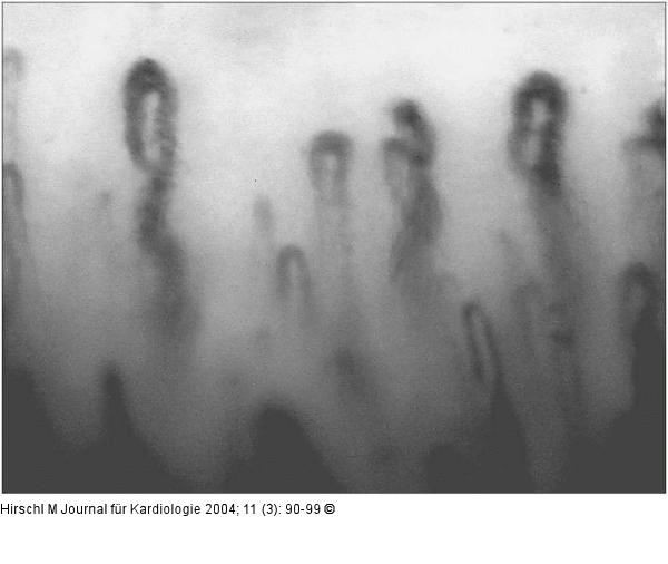 Raynaud-Phänomen