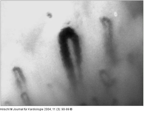 Raynaud-Phänomen