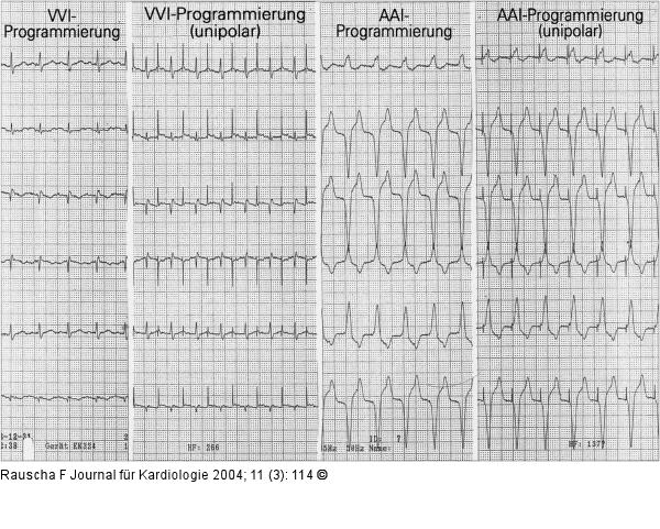 Schrittmacher-EKG - Elektrodenanschlußproblem