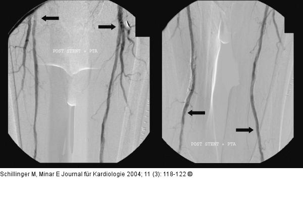 Arteria femoralis superficialis - Stent