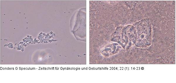 Lactobacillus-Grade - bakterielle Vaginitis