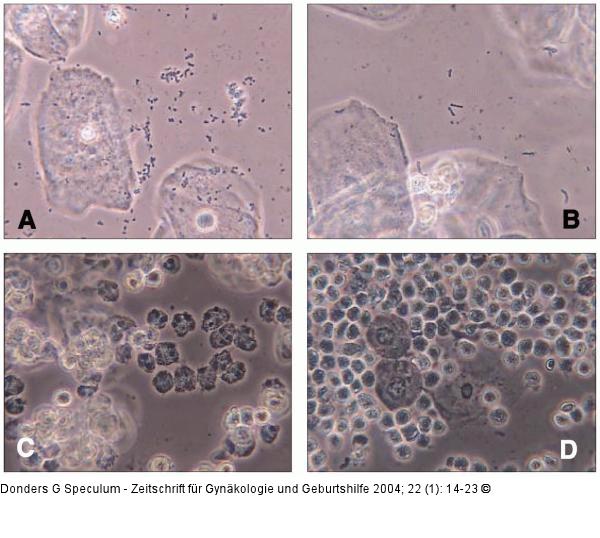Lactobacillus-Grade - aerobe Vaginitis