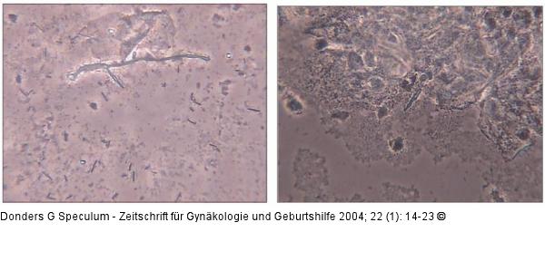 Candida vaginitis