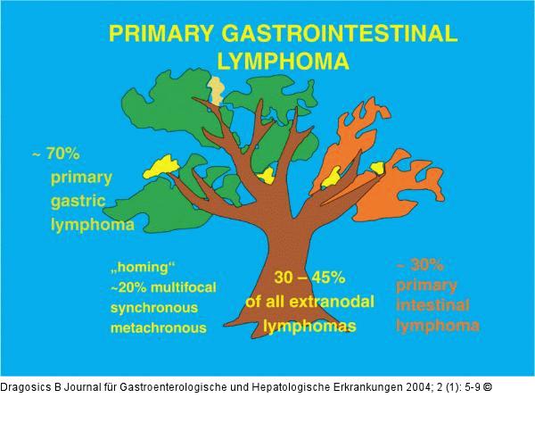Primäres gastrointestinales Lymphom