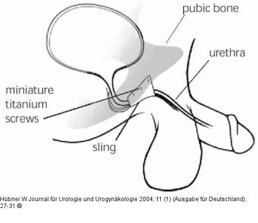 Harninkontinenz - Mann - Chirurgie