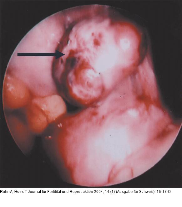 Leiomyomatöse Omentum majus-Neoplasie