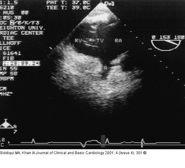 Rechtsatrialer Appendix