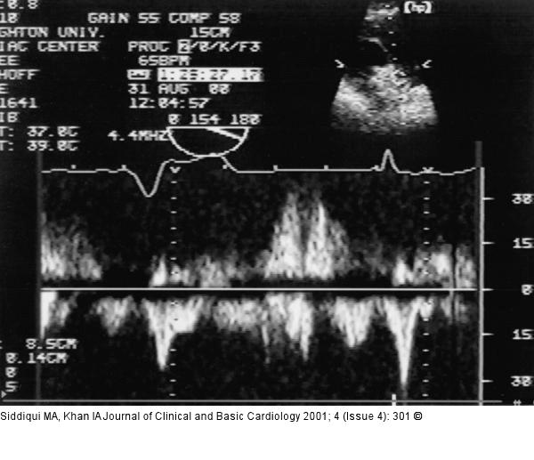 Rechtsatrialer Appendix