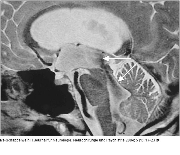 Hydrozephalus beim  Erwachsenen